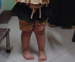 Best intoe-gait treatment in Pune