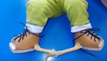 Dr Sameer Desai Clubfoot Treatment In India Bracing